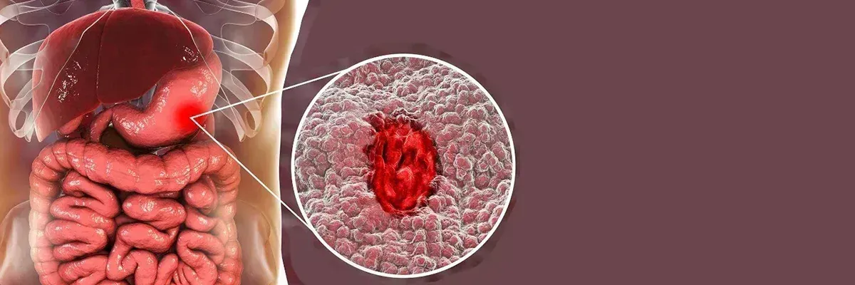 STOMACH / PEPTIC ULCERS